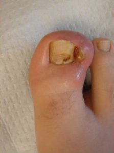 Ingrown Toe Nail